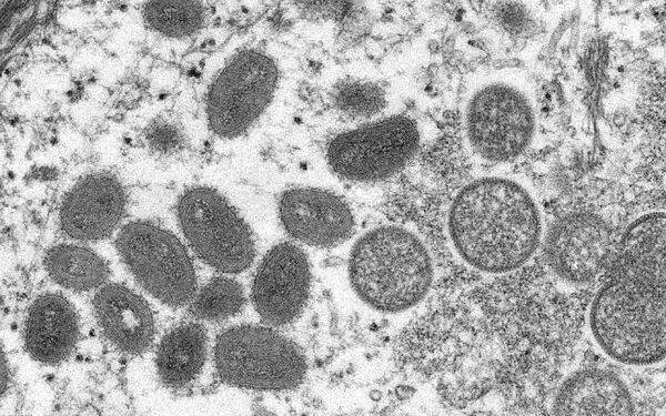 Ministère israélien de la Santé : « pas de menace d’épidémie de variole du singe, mais la vigilance doit être accrue »